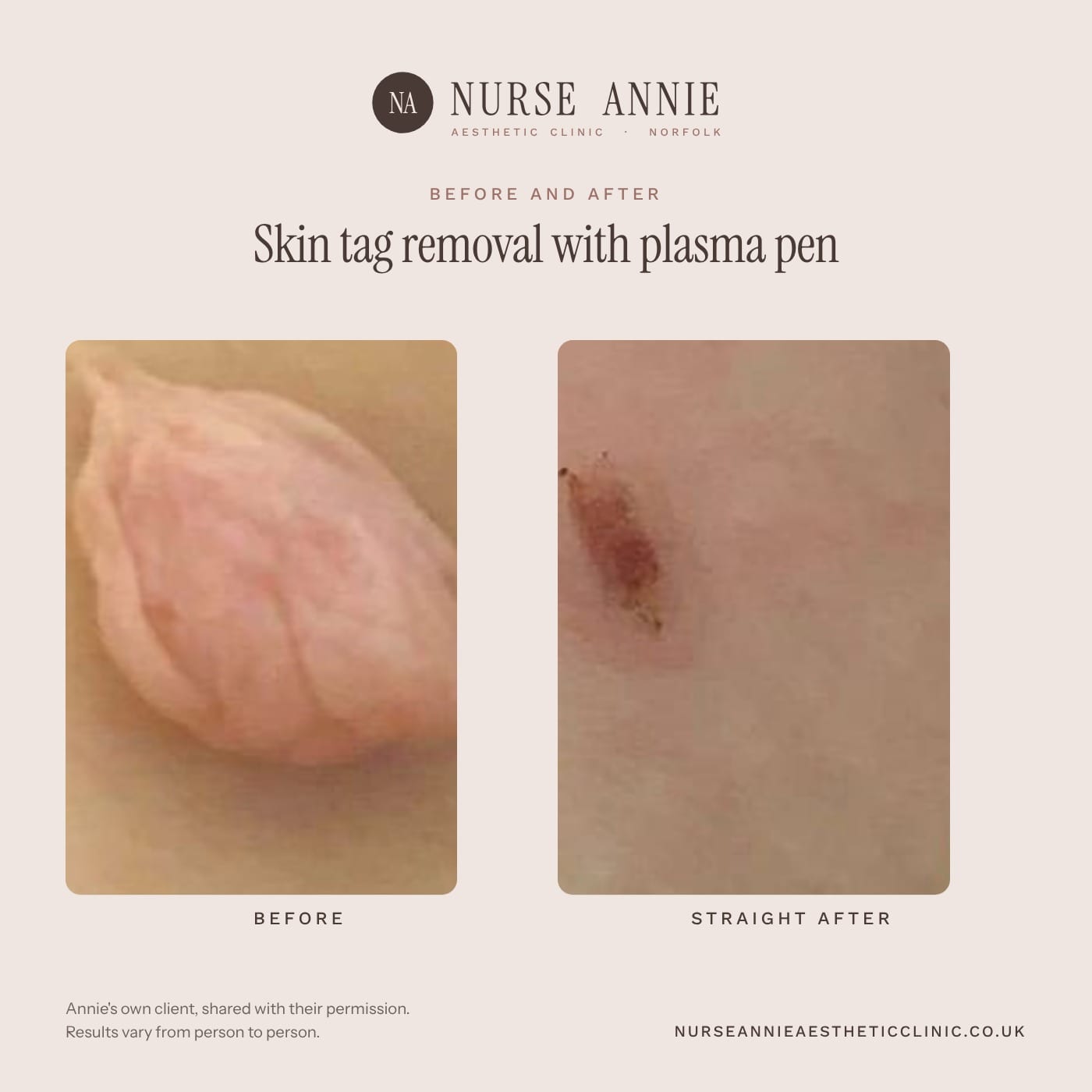 Before and after skin tag and lesion removal at Nurse Annie Aesthetic Clinic, Wymondham