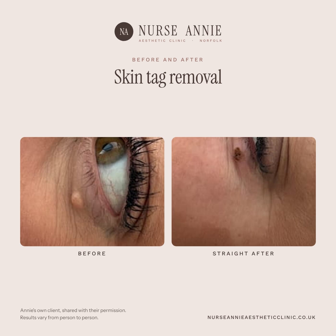 Before and after skin tag and lesion removal at Nurse Annie Aesthetic Clinic, Wymondham