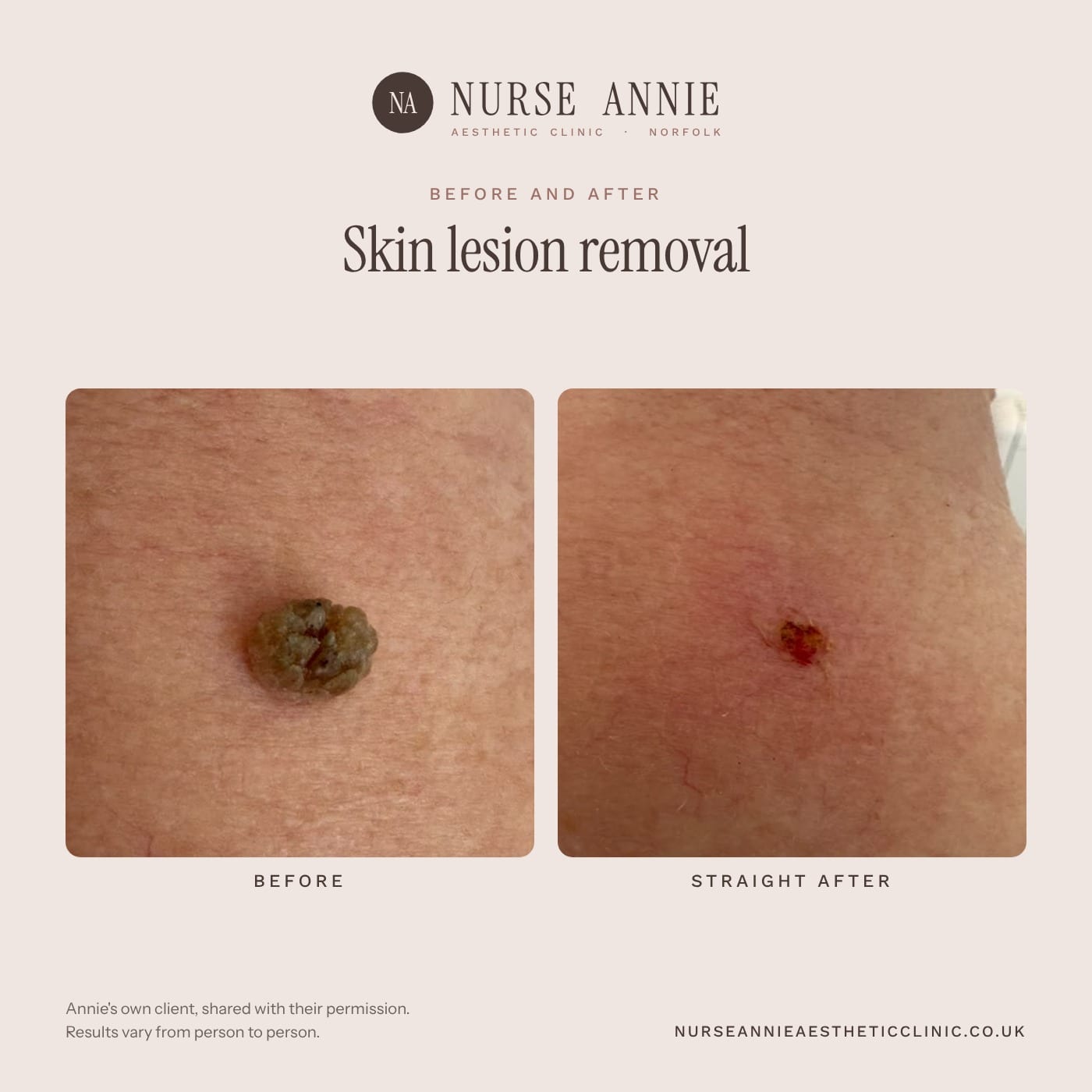 Before and after skin tag and lesion removal at Nurse Annie Aesthetic Clinic, Wymondham