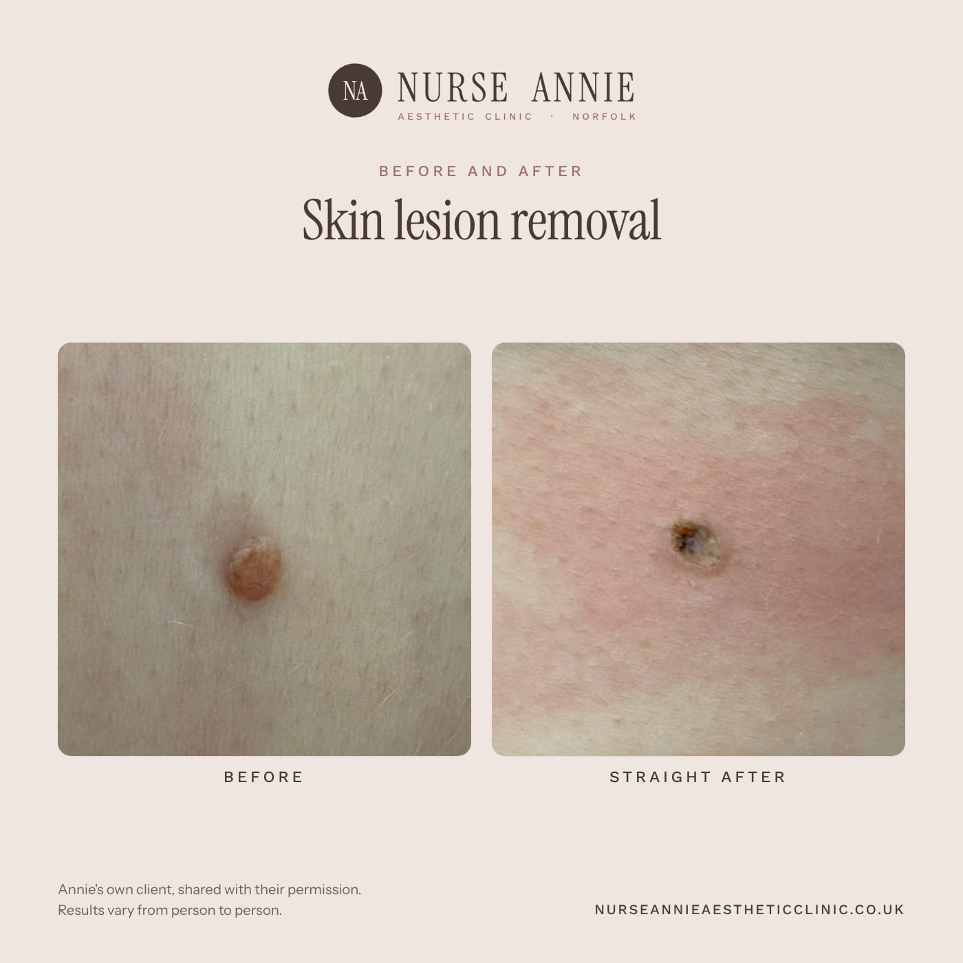 Before and after skin tag and lesion removal at Nurse Annie Aesthetic Clinic, Wymondham