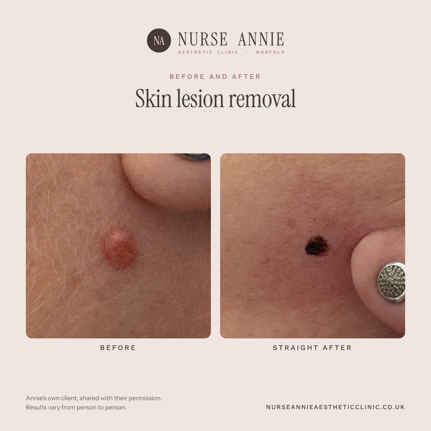 Before and after skin tag and lesion removal at Nurse Annie Aesthetic Clinic, Wymondham