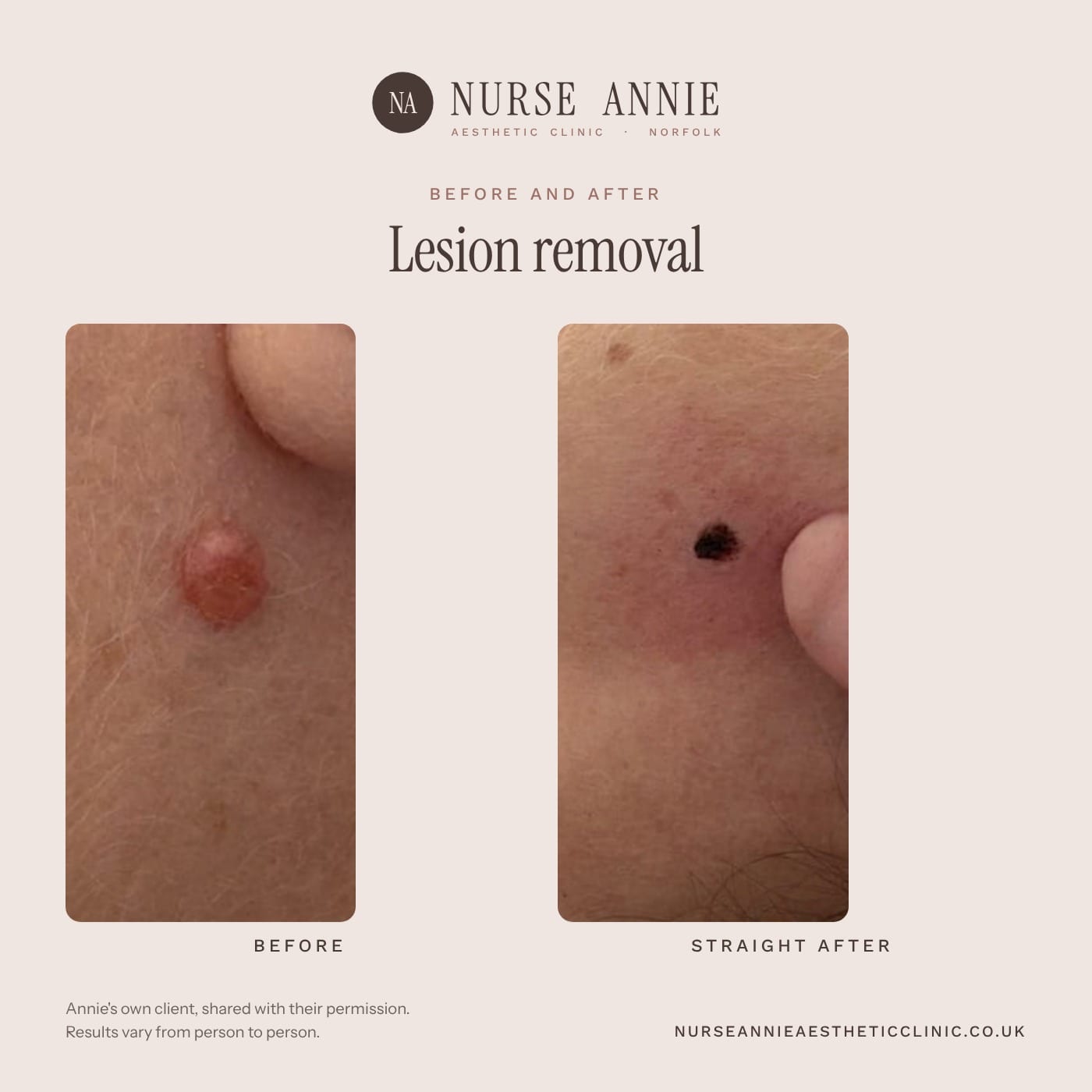 Before and after skin tag and lesion removal at Nurse Annie Aesthetic Clinic, Wymondham