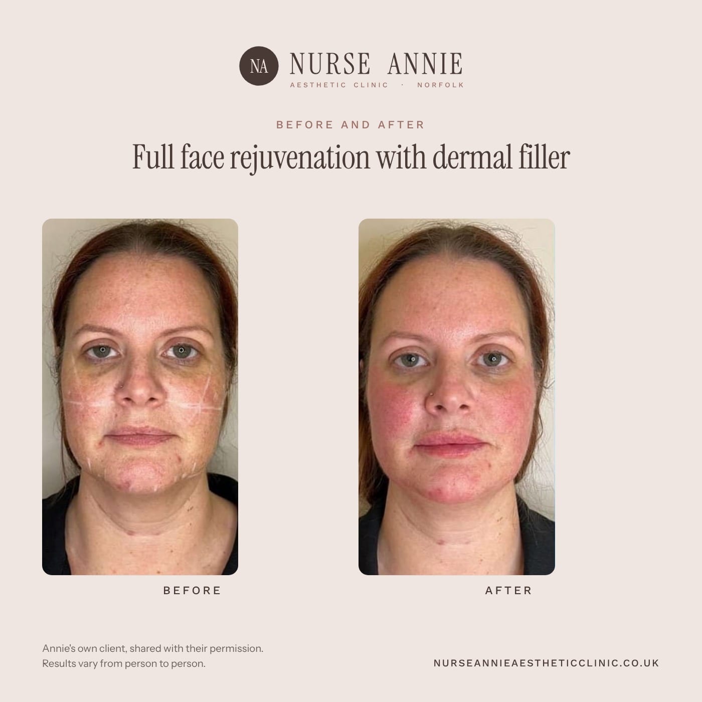 Before and after dermal filler at Nurse Annie Aesthetic Clinic, Wymondham