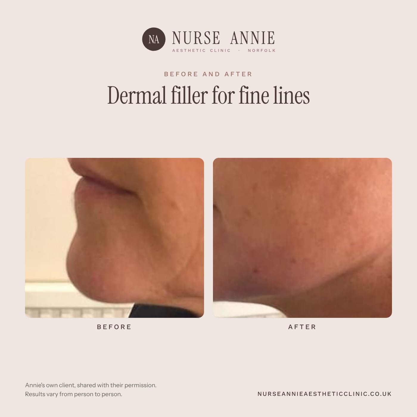 Before and after dermal filler at Nurse Annie Aesthetic Clinic, Wymondham