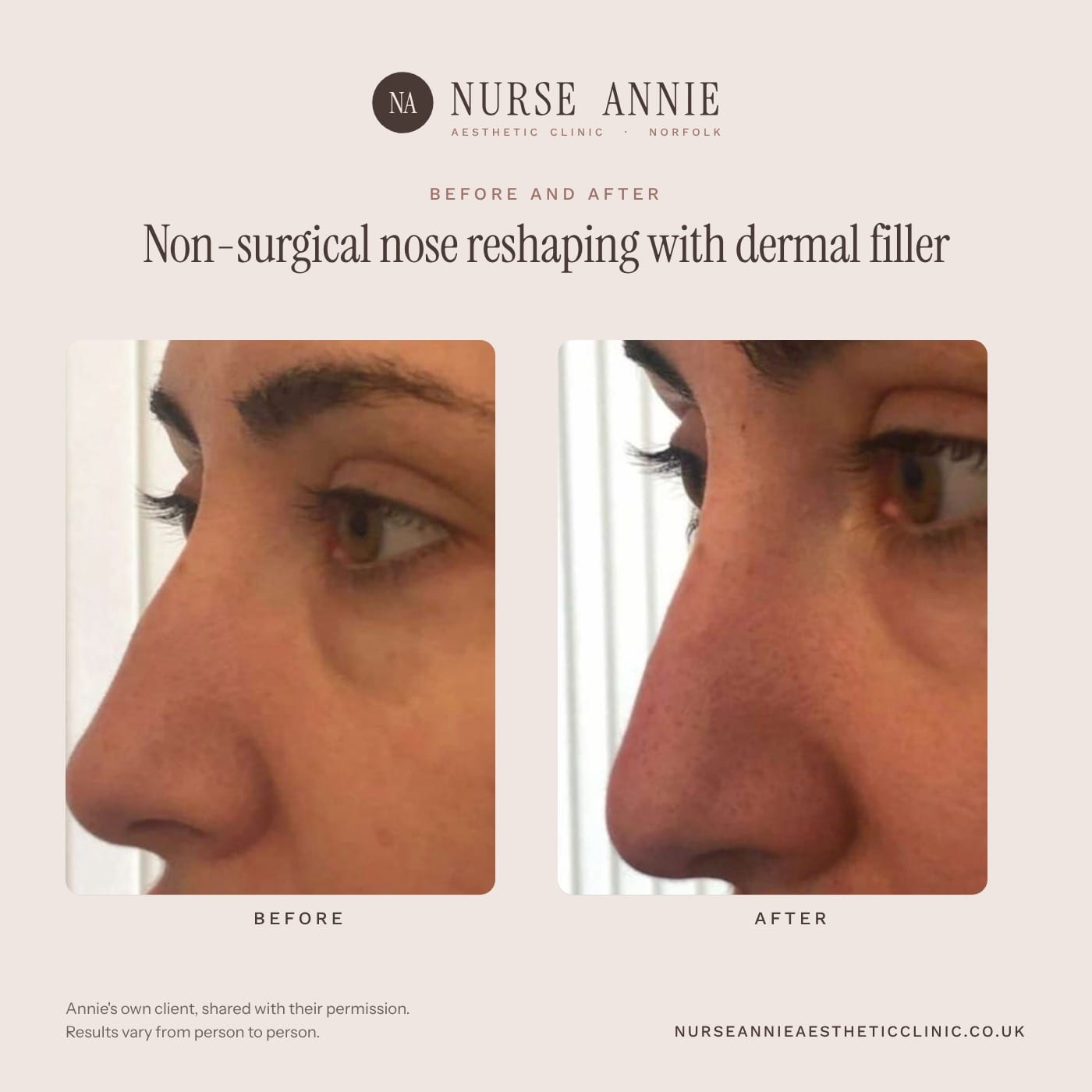 Before and after dermal filler at Nurse Annie Aesthetic Clinic, Wymondham