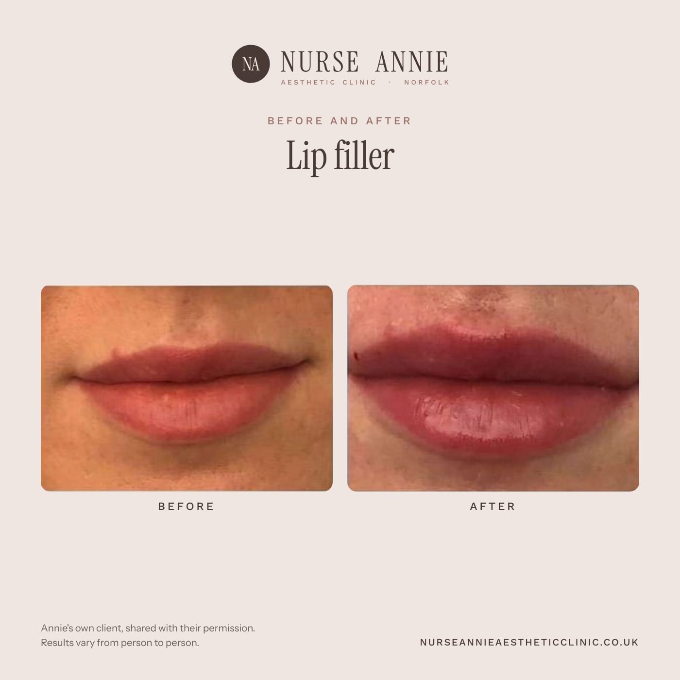 Before and after lip filler at Nurse Annie Aesthetic Clinic, Wymondham