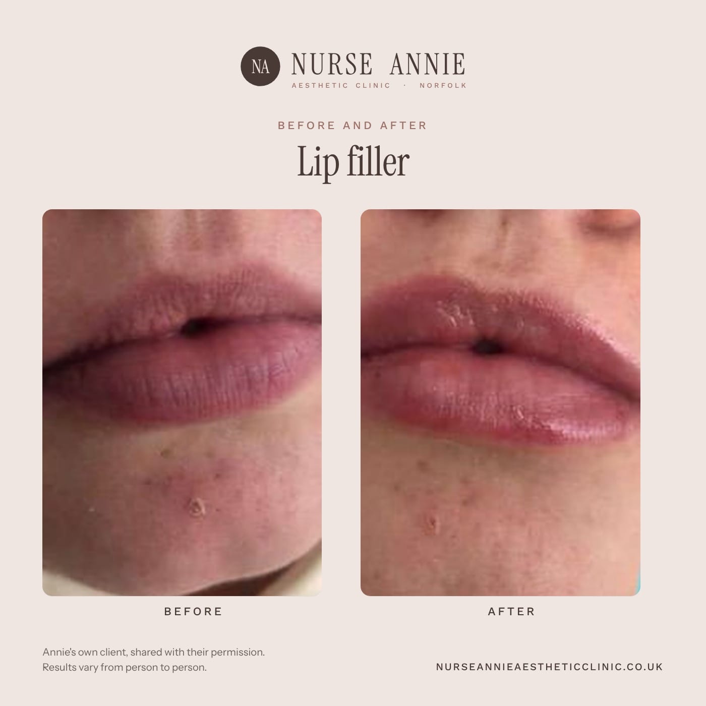 Before and after lip filler at Nurse Annie Aesthetic Clinic, Wymondham