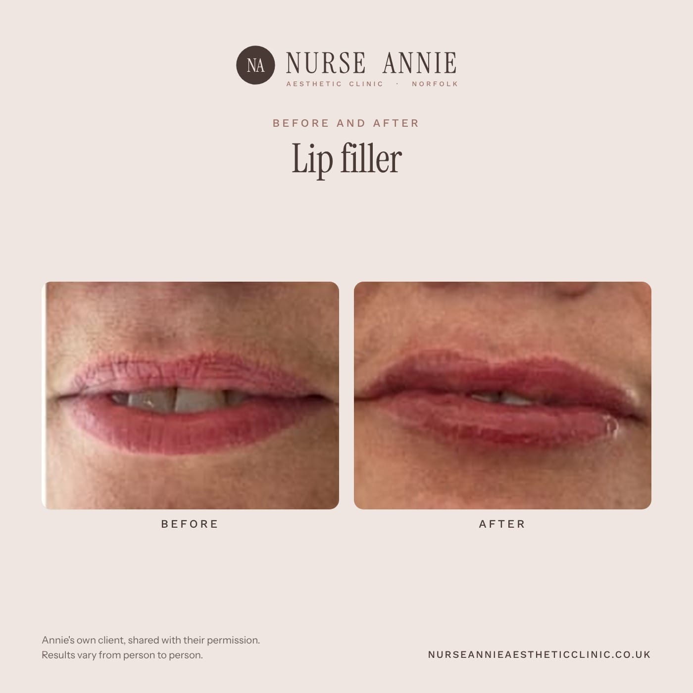 Before and after lip filler at Nurse Annie Aesthetic Clinic, Wymondham