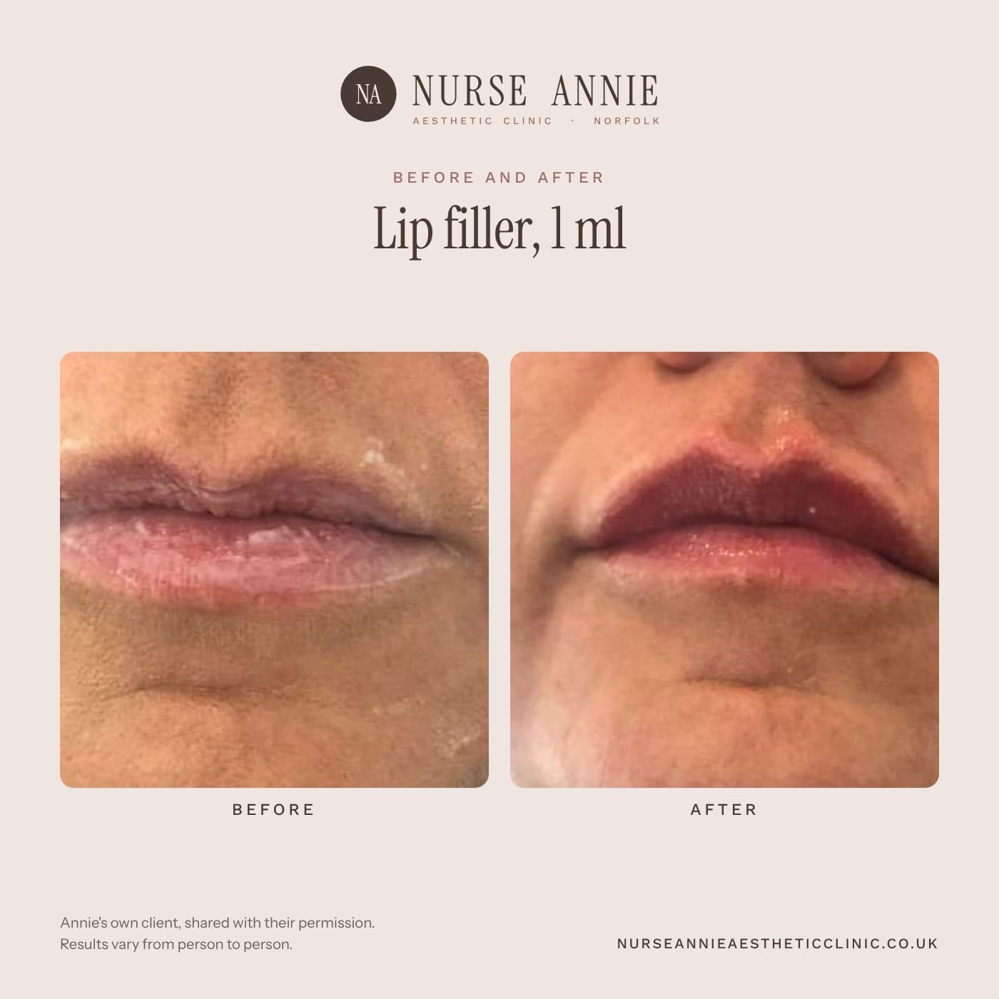 Before and after lip filler at Nurse Annie Aesthetic Clinic, Wymondham