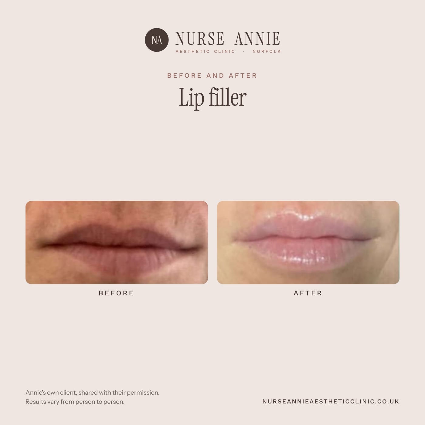 Before and after lip filler at Nurse Annie Aesthetic Clinic, Wymondham